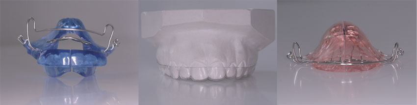 Tweede voorbeeld soorten beugels Orthodontist