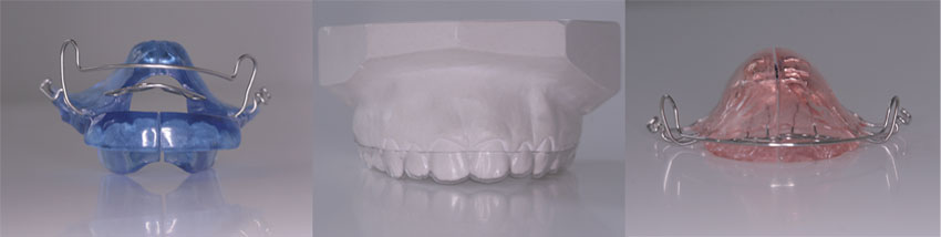 Tweede voorbeeld soorten beugels Orthodontist Tweede voorbeeld soorten beugels Orthodontist